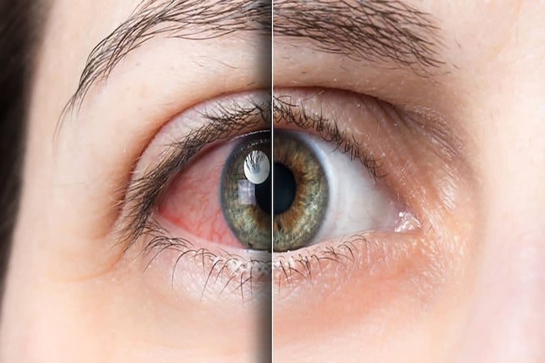 Dry Eye Syndrome | Jakarta Eye Center